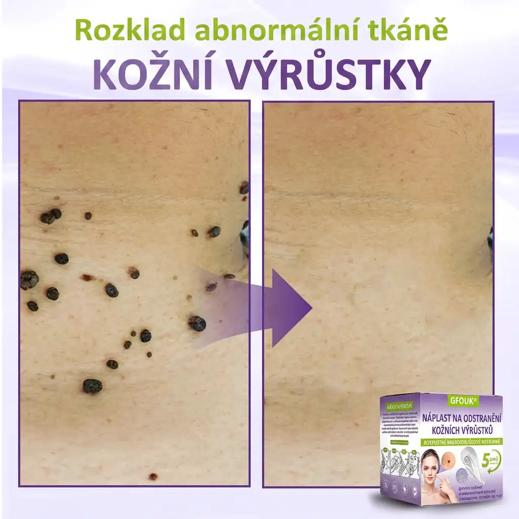 Vyrobeno a odesíláno z České republiky ✨ GFOUK® Rozpustné mikronáplasťové botanické náplasti na kožní výrůstky 🌴🌴