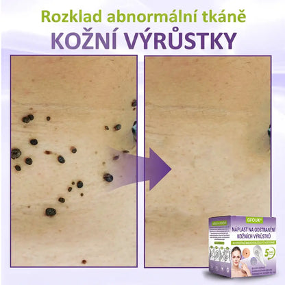 Vyrobeno a odesíláno z České republiky ✨ GFOUK® Rozpustné mikronáplasťové botanické náplasti na kožní výrůstky 🌴🌴