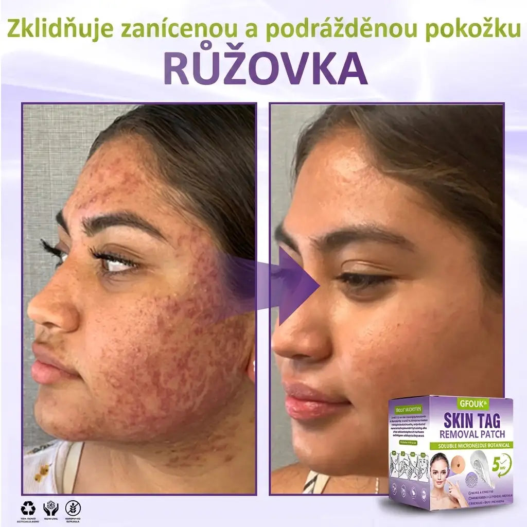Vyrobeno a odesíláno z České republiky ✨ GFOUK® Rozpustné mikronáplasťové botanické náplasti na kožní výrůstky 🌴🌴