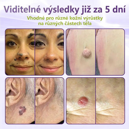 Vyrobeno a odesíláno z České republiky ✨ GFOUK® Rozpustné mikronáplasťové botanické náplasti na kožní výrůstky 🌴🌴