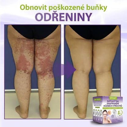 Vyrobeno a odesíláno z České republiky ✨ GFOUK® Rozpustné mikronáplasťové botanické náplasti na kožní výrůstky 🌴🌴